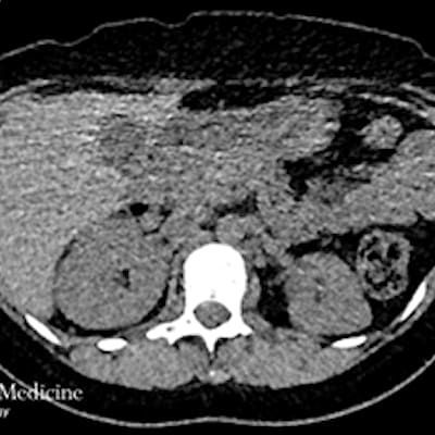 Bilateral Flank Pain