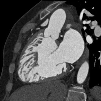 DanielVargasMD's tweet image. What is wrong with this picture? 🫀

#yesCCT #radiology #cvimaging #radres #cardiology #FOAMed  @NASCISociety @RadioGraphics @RadG_Editor @ThoracicImaging