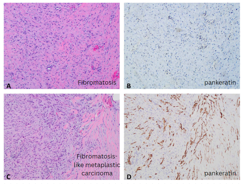 Janiranavarro's tweet photo. Breast
Fibromatosis vs fibromatosis like metaplastic carcinoma
Dr. Sun et al https://t.co/iQ47BfPMxc
#comparativepathology #PathX #PathTwitter #everydaybreast #breastpath #pathology https://t.co/0TgPx5lmVk