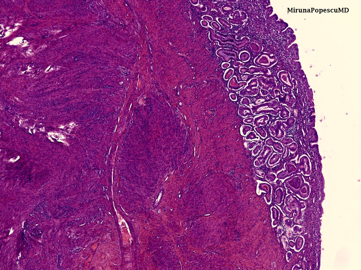 Some #pathbasics & #everydaygyn for a Tuesday evening 👇🏽
🔬Atypical endometrial hyperplasia overlying a leiomyoma.

#PathTwitter #PathX #pathresidents #gynpath