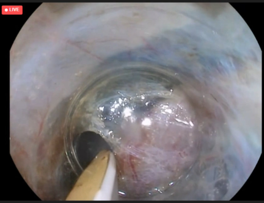 Dr Ahmir Ahmad (@drahmirahmad) on Twitter photo Great live endoscopy cases <a href="/kentendosurgery/">KENT EndoSurgery Course</a> today. Lots of tips about ESD fundamentals from @JTA_Endo & <a href="/NorikoSuzuki3/">Dr Noriko Suzuki 💙</a>. Good tip control critical, plan the dissection and work as a team. <a href="/tsiamoulos/">Zach Tsiamoulos</a> also performed a nice speedboat endoscopic submucosal tunneling dissection Great live endoscopy cases <a href="/kentendosurgery/">KENT EndoSurgery Course</a> today. Lots of tips about ESD fundamentals from @JTA_Endo & <a href="/NorikoSuzuki3/">Dr Noriko Suzuki 💙</a>. Good tip control critical, plan the dissection and work as a team. <a href="/tsiamoulos/">Zach Tsiamoulos</a> also performed a nice speedboat endoscopic submucosal tunneling dissection
