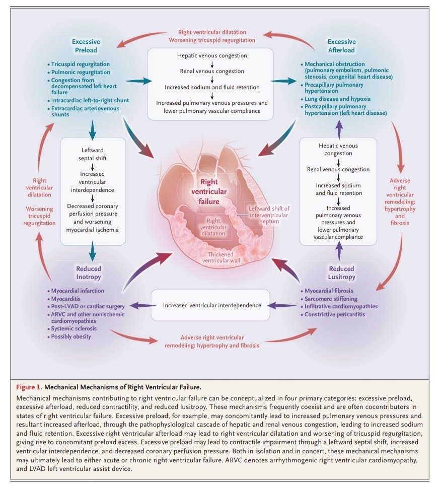 Leo_Santo5's tweet photo. Falla Ventricular Derecha ‼️🫀💥

🔰📚N Engl J Med 2023

DOI: 10.1056/NEJMra2207410

Enlace a Articulo Completo ✅👇🏼🆓️
https://t.co/BAL5fpiAx6 https://t.co/BFipeSo8SY
