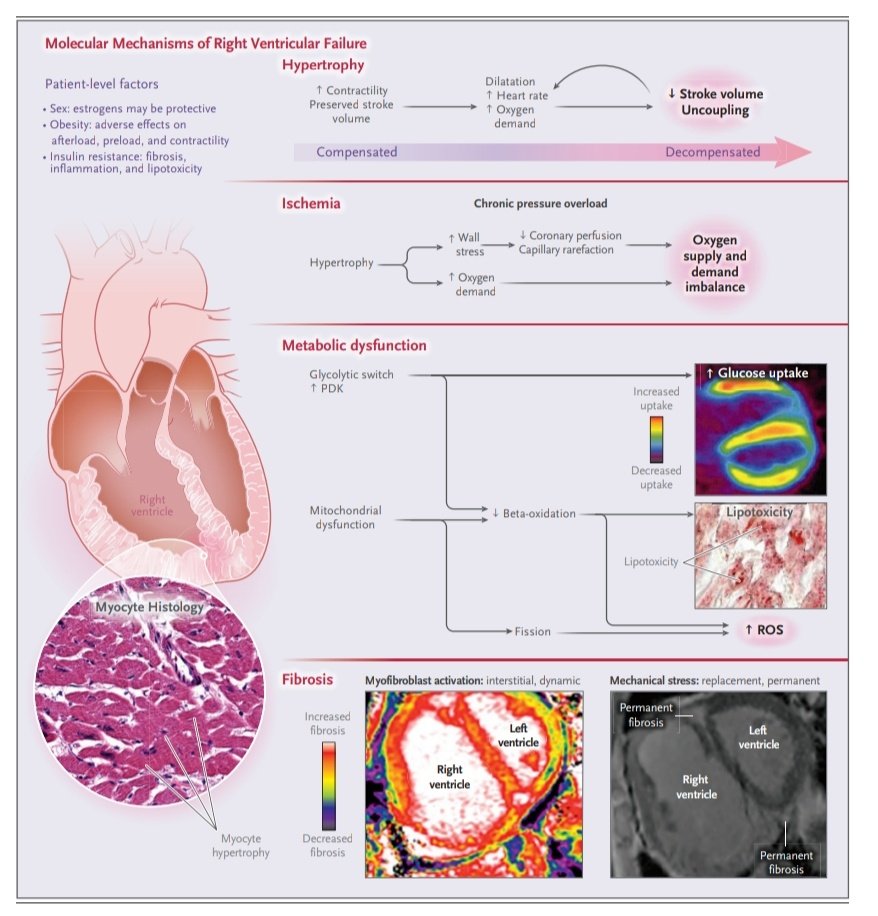 Leo_Santo5's tweet photo. Falla Ventricular Derecha ‼️🫀💥

🔰📚N Engl J Med 2023

DOI: 10.1056/NEJMra2207410

Enlace a Articulo Completo ✅👇🏼🆓️
https://t.co/BAL5fpiAx6 https://t.co/BFipeSo8SY