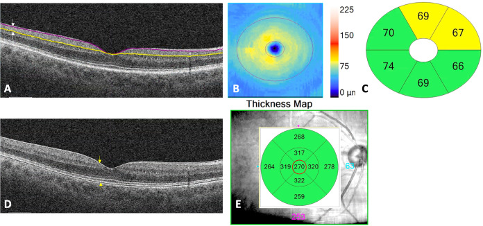 AAOjournal's tweet photo. Using OCT and OCT Angiography we found that individuals with Parkinson Disease experience more rapid loss of retinal microvasculature and more rapid thinning of the ganglion cell layer compared to controls. https://t.co/YloPwrGz5O https://t.co/uSvXO8PLGx