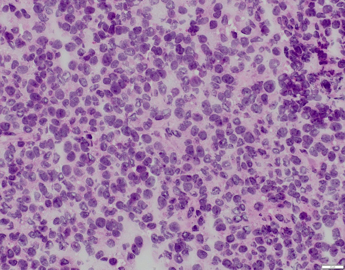 bitar_mireille's tweet image. “Small round blue cell tumor “ in a thigh mass; positive for CD99 and NKX2.2 IHCs, what molecular testing can further support the diagnosis🤔

#bstpath #pedipath #surgpath #molecpath #cytogenetics #pathtwitter
