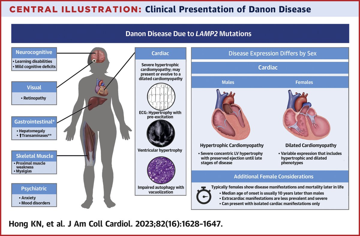 Danon disease is a rare X-linked myopathy associated with severe #heartfailure. This #JACC state-of-the-art review highlights the pathophysiology, diagnosis, & management of this important disease process: bit.ly/3rIbm2F @EricAdler17 #CardioTwitter