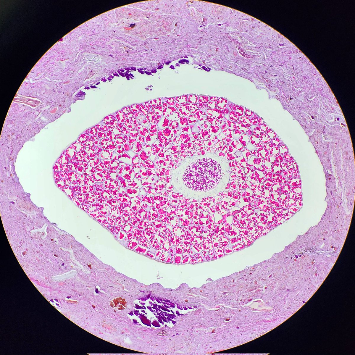 Eye spy, with my microscope, a little seed within a fecalith. #PathArt