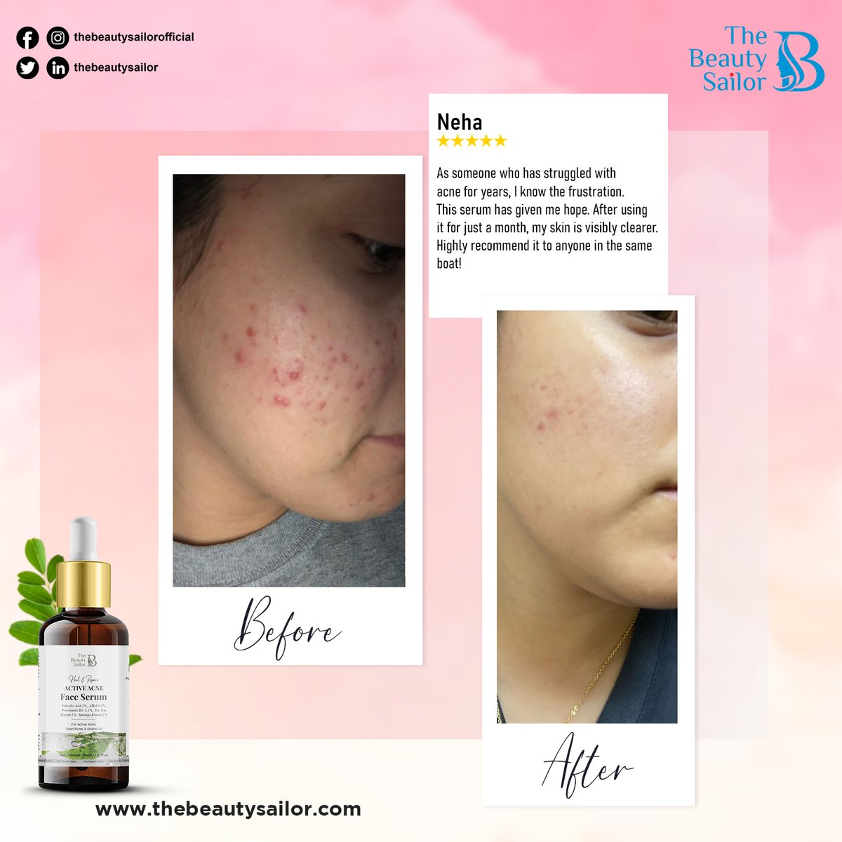 TheBeautySailor's tweet image. Thank you for trusting us on your skincare journey! Our Heal &amp;amp; Repair Active Acne Face Serum is your solution for stubborn acne. 🤗

Product link- thebeautysailor.com/products/activ…
.
.
#activeacnefaceserum #salicylicacid #teatree #customerreview #happycustomer #testimonial