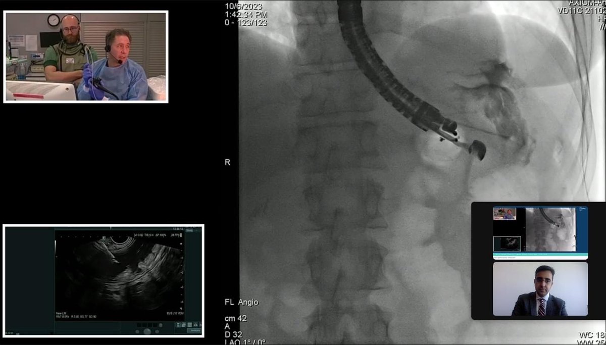 Honored to be part of EUS skyline. Showcased live EUS procedures from acros the the centers from the world. Gr8 to be a part of the discusn comparing 2 newer endoscopic necrosectomy devices and moderate live demos of single sessionEDGE and eus PFC drainage procedures #gitwitter