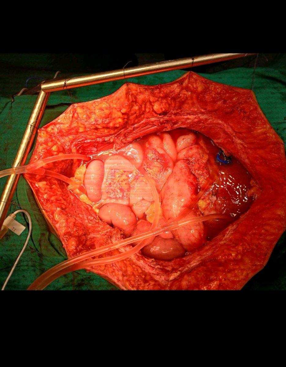 Deeplamichhane3's tweet photo. Happy to share that we are able to start HIPEC services in Nepal at Bhaktapur Cancer Hospital, Kathmandu.
First case recovering well and second posted today. 
Learning over the years and finally execution gives motivation. https://t.co/VdzEYeQQm1