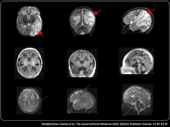 King's College London (@kingscollegelon) on Twitter photo Detecting brain conditions in newborn babies could become more accessible and more affordable by using portable MRI scanners.
That's thanks to a major advance in research, led by <a href="/PaulCawleyUK/">Paul Cawley</a> (<a href="/KingsImaging/">Biomedical Engineering & Imaging Sciences</a> <a href="/Kings_PFIG/">Kingās Perinatal Functional Imaging Group</a>) and <a href="/EvelinaLondon/">Evelina London</a>.
Learn more ā¬
kcl.ac.uk/news/major-adv⦠Detecting brain conditions in newborn babies could become more accessible and more affordable by using portable MRI scanners.
That's thanks to a major advance in research, led by <a href="/PaulCawleyUK/">Paul Cawley</a> (<a href="/KingsImaging/">Biomedical Engineering & Imaging Sciences</a> <a href="/Kings_PFIG/">Kingās Perinatal Functional Imaging Group</a>) and <a href="/EvelinaLondon/">Evelina London</a>.
Learn more ā¬
kcl.ac.uk/news/major-advā¦