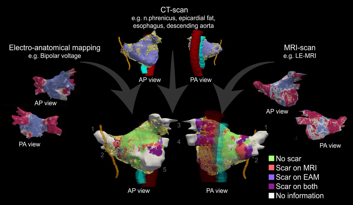 🆕📰Our algorithm can automatically and reliably align pre-procedural cardiac images (CT/MRI) with anatomies acquired during ablation procedures. This enables multi-modal characterization of the LA🫀 @Dominik_Linz @UliSchotten @MirandaBijvoet @kvernooy tinyurl.com/ycycmjj4