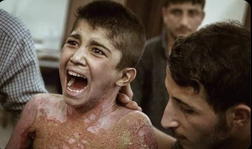 iAmHaks's tweet photo. A Kurdish child called Mohammed Hamid was burnt by Turkish bombs using phosphorus gas in 2019. Turkey continues to bomb Kurds today. Today, Turks are using his picture to call him a Palestinian child attacked by Israel. How ironic. Let everyone see the truth. https://t.co/OWBEmXzqc6