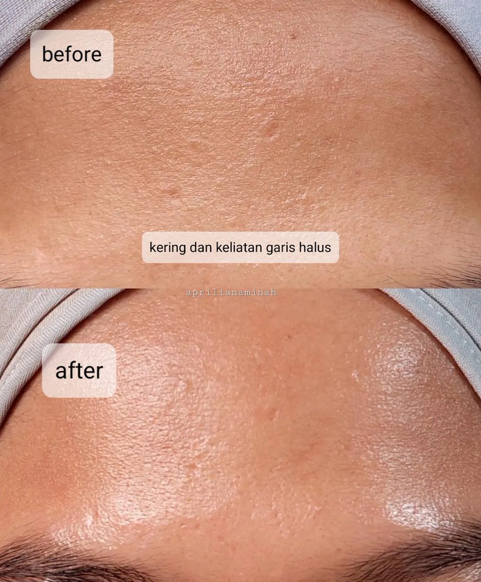 aprlcamera's tweet photo. kalian tau kan vitamin C dipakai pagi hari bisa bikin kulit lebih cerah glowing dan retinol untuk anti-aging yg bisa dipakai malam.. nah perpaduan 2 bahan actives ini yang bikin kulit ku terlihat sehat dan gak kusam.
#savetheskin #racuninskincare #mightybooster https://t.co/LEcmFZD4qr