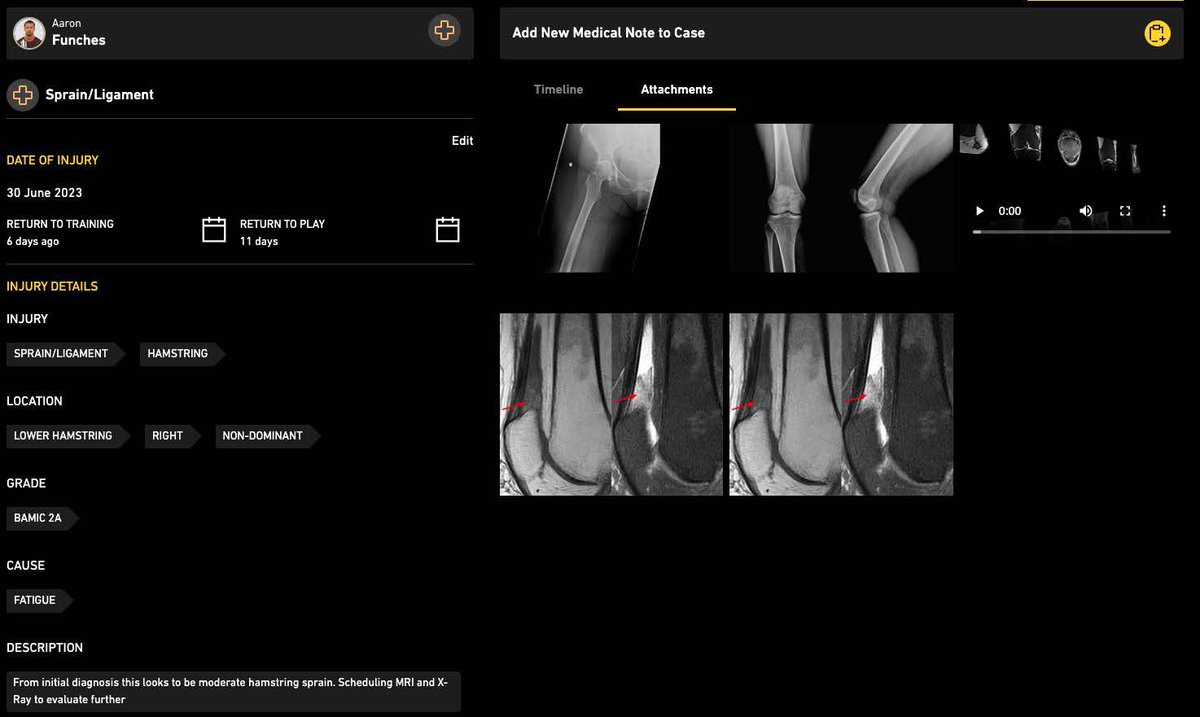 ORRECO1's tweet photo. Our Medical Notes module is available now through the @ORRECO1 Te@m Platform

Built with and in use by teams playing in @premierleague @MLS @LaLiga and the Saudi Pro League, Medical Notes was developed in the field with Elite Medical and Performance Practitioners. 

Medical Notes allows Te@m users to -

Log Injury / Illness records for their Athletes

Manage both Return to Training (RTT) and Return to Play (RTP)

Upload videos, medical scans, text notes and voice notes related to the injury directly to the platform

Medical Notes is part of the Te@m modular platform and seamlessly interconnects with our existing BioMarkers 3.0, Recovery Lab, Wellness Tracking, Menstrual Health, Content Creation, Travel Planner @Thlete app and other modules.

Contact us at info@orreco.com to schedule a demo

#team #medicalnotes #recovery #biomarkers #personalized #datascience #sportscience #athlete @Thlete