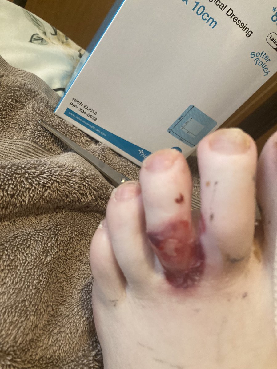 yozza21Mv's tweet photo. Chemotherapy is having a proper go at my feet and and Toes hey ho we shall overcome https://t.co/zoUOLMCWMP