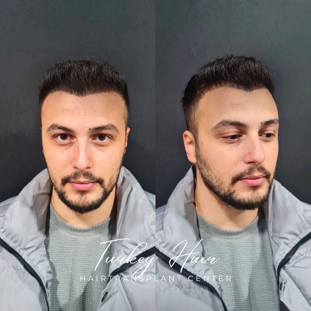 TurkeyHairCentr's tweet photo. HAPPY PATIENT WITH  HAIR TRANSPLANT TURKEY  ✨💯 

Book your appointment today and take the first step towards a new you!  
✨https://t.co/g9xcnCPQLF……   

💻https://t.co/rjpou2eduG 

📧turkeyhairgroup@gmail.com
Egypt | ISIS | Netanyahu | Islam | Gaza | Isreal | Harvard | Creed https://t.co/ZSD3ZnnhIO