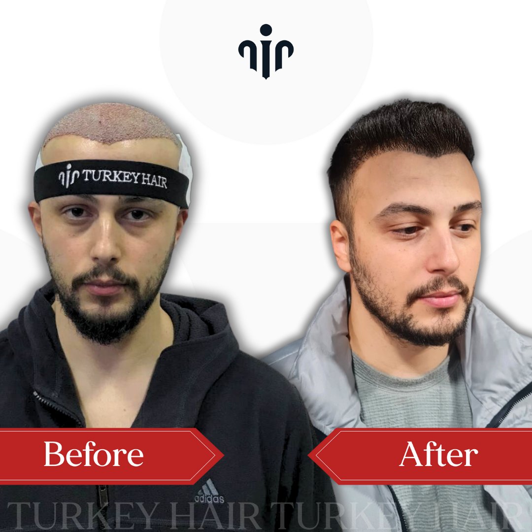 TurkeyHairCentr's tweet photo. HAPPY PATIENT WITH  HAIR TRANSPLANT TURKEY  ✨💯 

Book your appointment today and take the first step towards a new you!  
✨https://t.co/g9xcnCPQLF……   

💻https://t.co/rjpou2eduG 

📧turkeyhairgroup@gmail.com
Egypt | ISIS | Netanyahu | Islam | Gaza | Isreal | Harvard | Creed https://t.co/3OUJkK3aIc