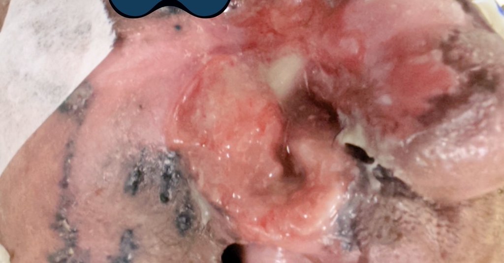 DineshMakuny's tweet image. It makes no sense to invest on a ring and gantry linac paying over 12 Cr if a dept has no other facility for treating with an #electronbeam,the #poormansprotons.A case of #BasalCell Ca  face salvaged with an electron beam.
#radtwitter ,@Sushilberiwal
#medtwitter