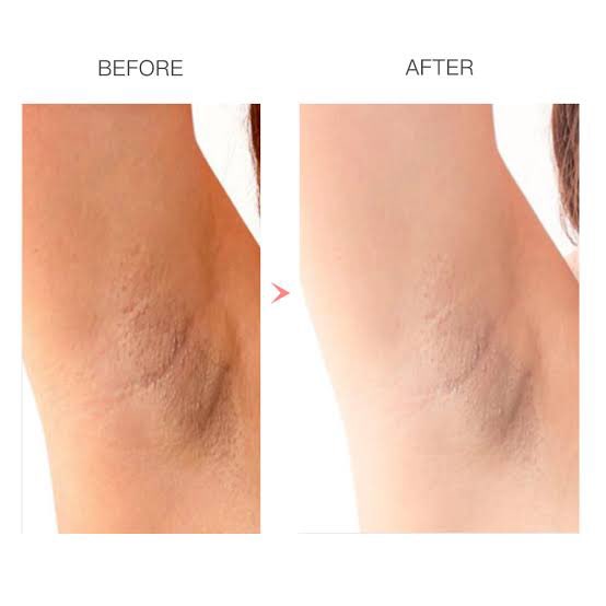 CARA CERAHIN KETIAK &amp; LIPATAN DENGAN AMPUH !

— a thread