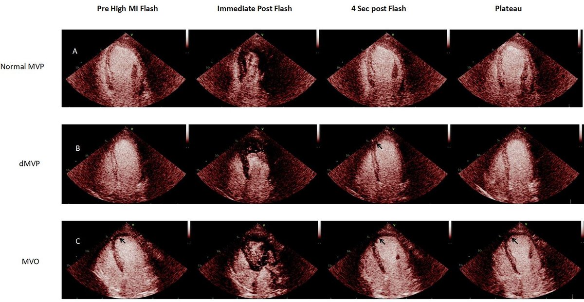 This study aims to explore the prognostic implications of segmental noninvasive myocardial work (MW) and microvascular perfusion (MVP) after ST-segment elevation myocardial infarction (STEMI).

Read our <a href="/JournalASEcho/">JASE</a> article: bit.ly/3LSLDeL