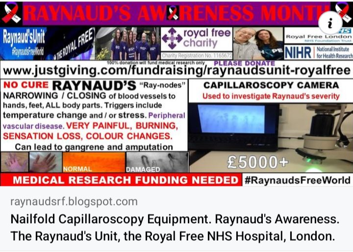 cosmicfairy444's tweet photo. October #RaynaudsAwarenessMonth 
Nailfold Capillaroscopy equipment: 
https://t.co/QAOmEEJF97
#RaynaudsFreeWorld #Research #Raynauds
https://t.co/RS5IfuVstI 
#Vasospasm #BlueFingers #BlueToes #Pain #DigitalUlcers #Gangrene #Amputation  #VascularNeuropathy #RaynaudsAwareness https://t.co/ggKevNaqK5