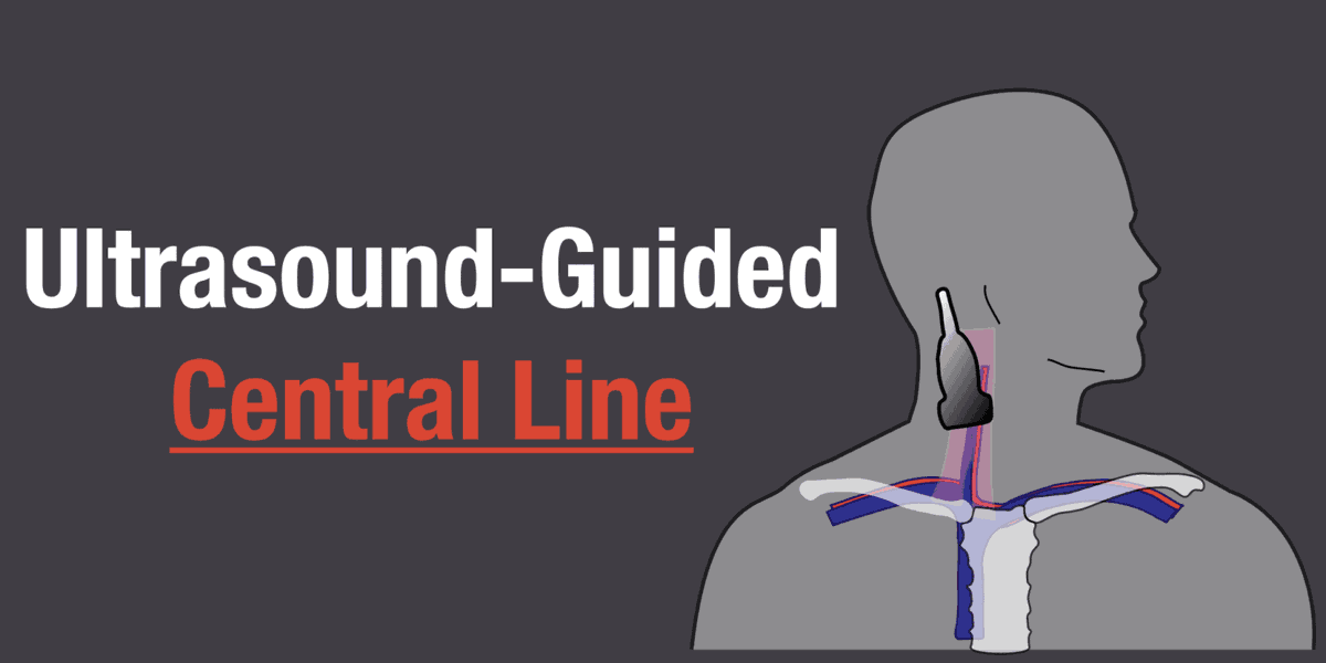 How confident are you with #centrallineplacement? Did you know that “Using #ultrasound to guide your central line placement can reduce the time needed to complete the procedure, the number of complications, and the number of catheter misplacements?”
ow.ly/MoOw50PSIj8