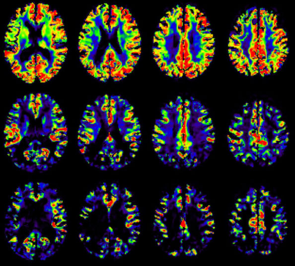 Influence of cerebral blood flow on volumetric loss related to Alzheimer’s disease. bit.ly/46nGQKl. #Alzheimer #OpenAccess #Neurology
