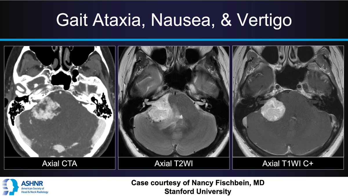 ASHNR (@ashnrsociety) on Twitter photo #ASHNRCOTW #230: Gait ataxia, nausea, & vertigo. Dx? Thx <a href="/nancyfstanford/">Nancy Fischbein</a> 4 case! #ASHNR24
Answer w/ appropriate GIF only -- stay professional & don't spoil it!
<a href="/DShatzkes/">Deborah Shatzkes</a> <a href="/CDP_Rad/">C Douglas Phillips šŗšø</a> <a href="/callyrobs/">Caroline Robson, MBChB</a> <a href="/rhwiggins/">Richard Wiggins</a> <a href="/nakoontz/">Nicholas Koontz</a> <a href="/cmtomblinson/">Courtney Tomblinson, MD</a> <a href="/ESHNRSociety/">ESHNR</a> <a href="/CMGlastonbury/">Christine M Glastonbury, MD</a> <a href="/AshokSrini15/">Ashok Srinivasan</a> <a href="/RadRupa/">Rupa Radhakrishnan</a> #ASHNRCOTW #230: Gait ataxia, nausea, & vertigo. Dx? Thx <a href="/nancyfstanford/">Nancy Fischbein</a> 4 case! #ASHNR24
Answer w/ appropriate GIF only -- stay professional & don't spoil it!
<a href="/DShatzkes/">Deborah Shatzkes</a> <a href="/CDP_Rad/">C Douglas Phillips šŗšø</a> <a href="/callyrobs/">Caroline Robson, MBChB</a> <a href="/rhwiggins/">Richard Wiggins</a> <a href="/nakoontz/">Nicholas Koontz</a> <a href="/cmtomblinson/">Courtney Tomblinson, MD</a> <a href="/ESHNRSociety/">ESHNR</a> <a href="/CMGlastonbury/">Christine M Glastonbury, MD</a> <a href="/AshokSrini15/">Ashok Srinivasan</a> <a href="/RadRupa/">Rupa Radhakrishnan</a>