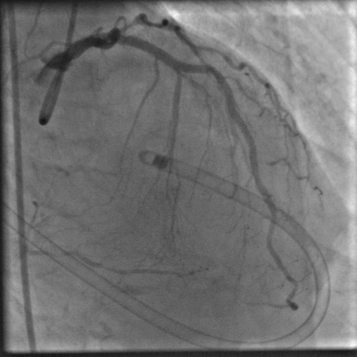 morrethound's tweet photo. CHIP starting with #SAFARI and peripheral stenting for left CFA CTO recanalization and #IABP implantation, #rotationalatherectomy with 1.75 mm burr, PTCA, anchoring technique for distal DES delivery, and finally #leftmain stenting using #DKcrush technique with good  final results https://t.co/zjghK9xXfu