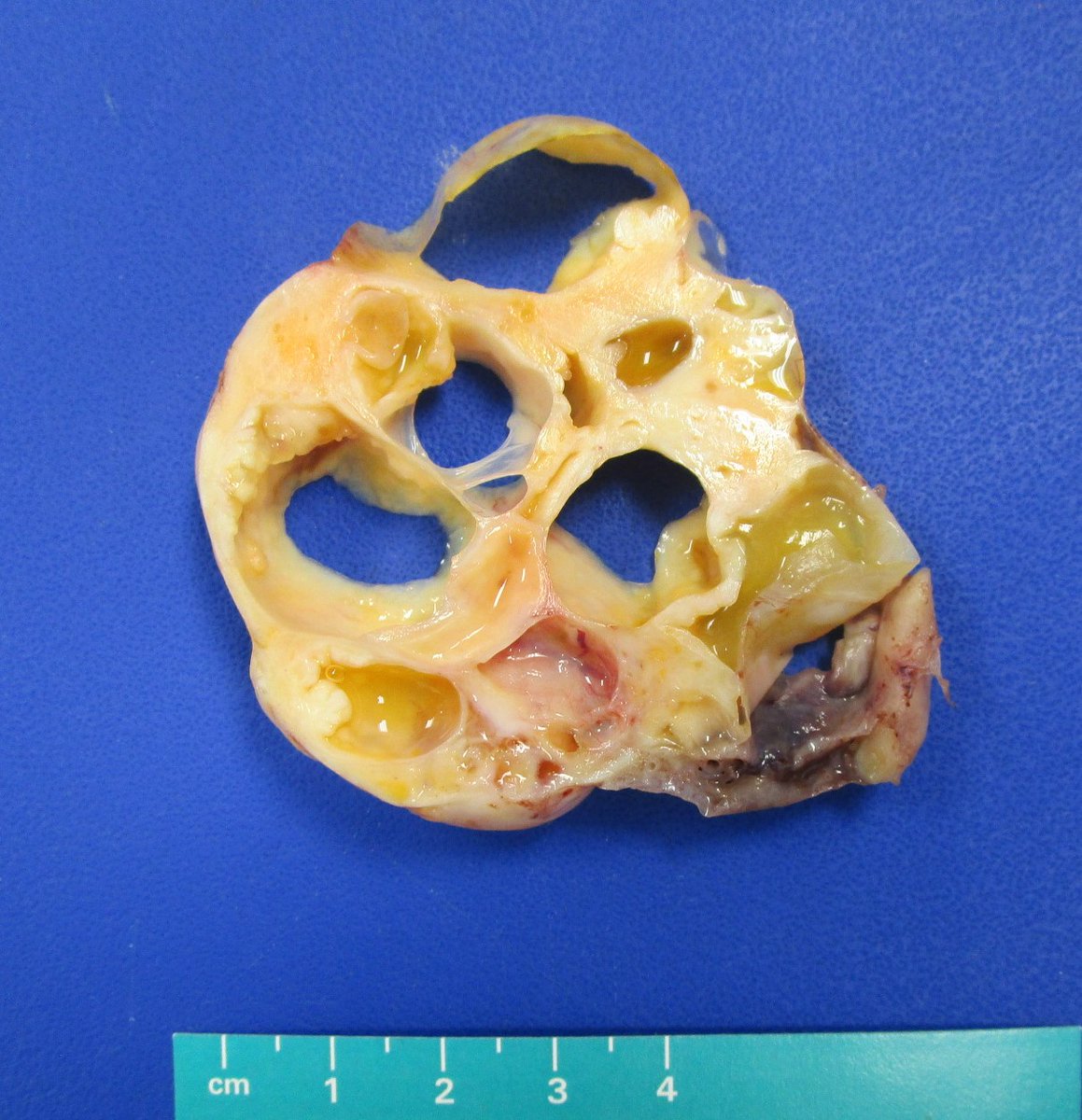 MhPathology's tweet image. Congratulations to PGY3 @MalekAsfar, winner of this quarter's gross photography award @MhPathology ! 
#grosspath
Can you identify the organ and diagnosis from these pictures? We can!