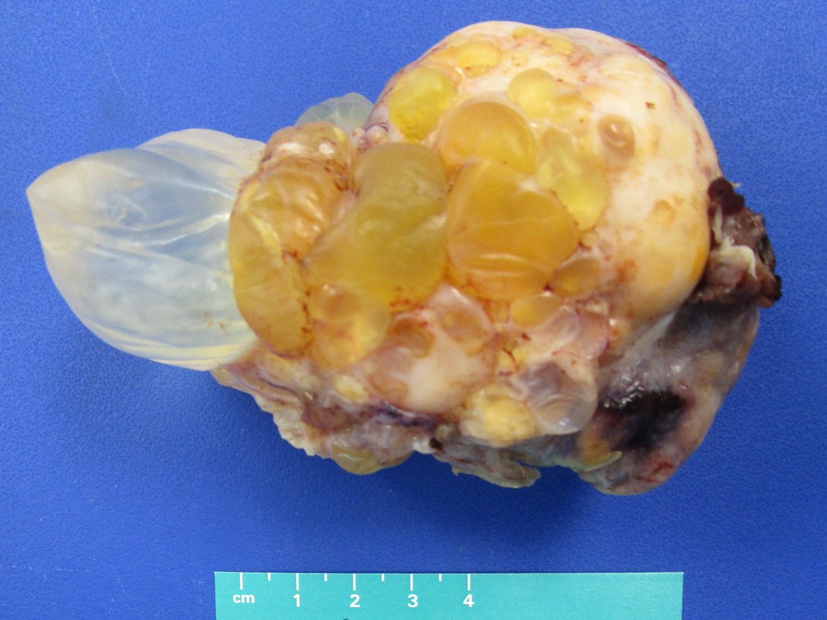 MhPathology's tweet image. Congratulations to PGY3 @MalekAsfar, winner of this quarter's gross photography award @MhPathology ! 
#grosspath
Can you identify the organ and diagnosis from these pictures? We can!
