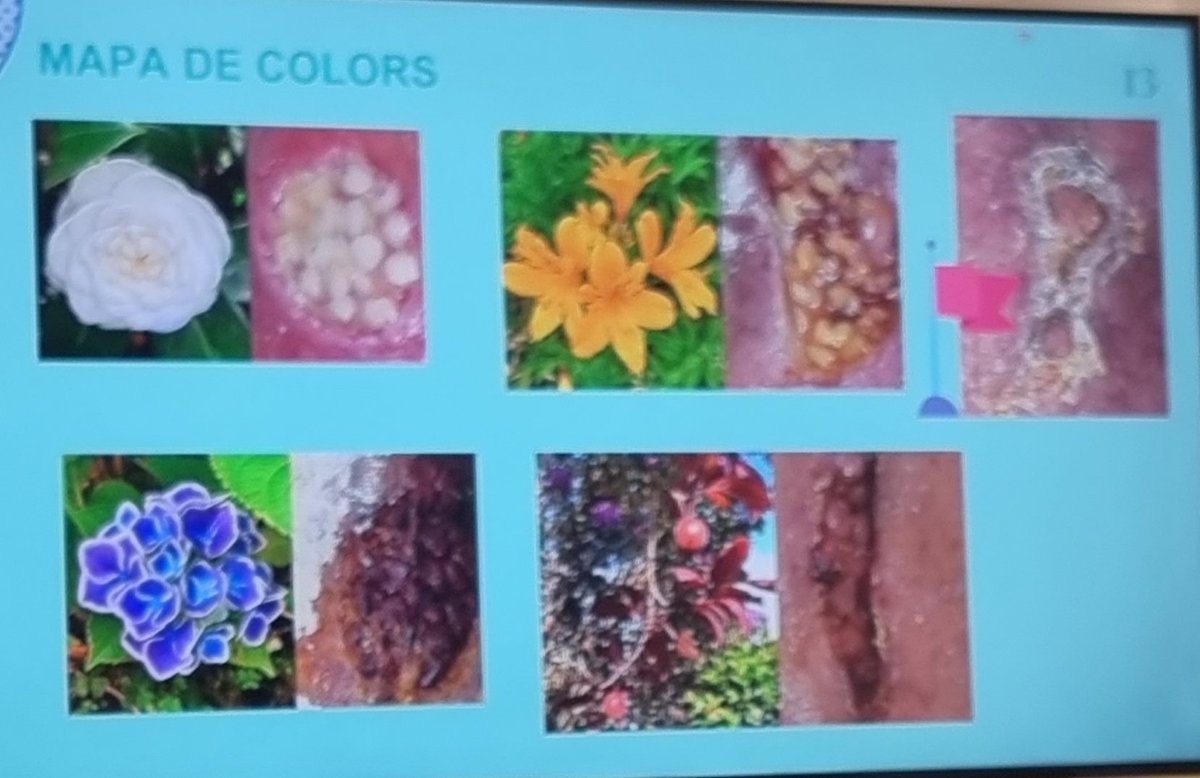 L'Anna Garcia,infermera referent de ferides,ens explica el que fem a l'AP de SSIBE:empelt segell👏.Tenim persones amb ferides que es poden beneficiar d'aquesta tècnica?Jo en tinc dos per agendar👍. Avancem!!
<a href="/_ssibe/">SSIBE</a> 
#ABSPalafrugell
<a href="/AnnaGarmm/">Anna Garcia</a> 
#atencionprimaria