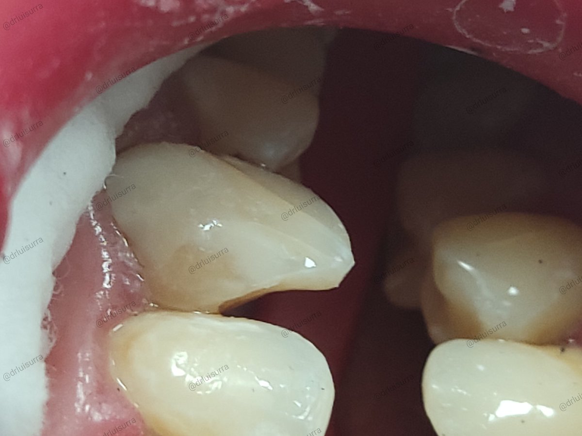 drluisurra's tweet photo. El antes y el después de una caries bastante "aparatosa" y profunda. 😳😳😳
.
.
.
#dentista #odontologia #dientesblancos #dentistry #stunningsmile #cadcam #Irapuato #guanajuato #dentist #endodoncia #rootcanal #protesisdental #bichectomia #esteticadental https://t.co/ifRp7RKhGn