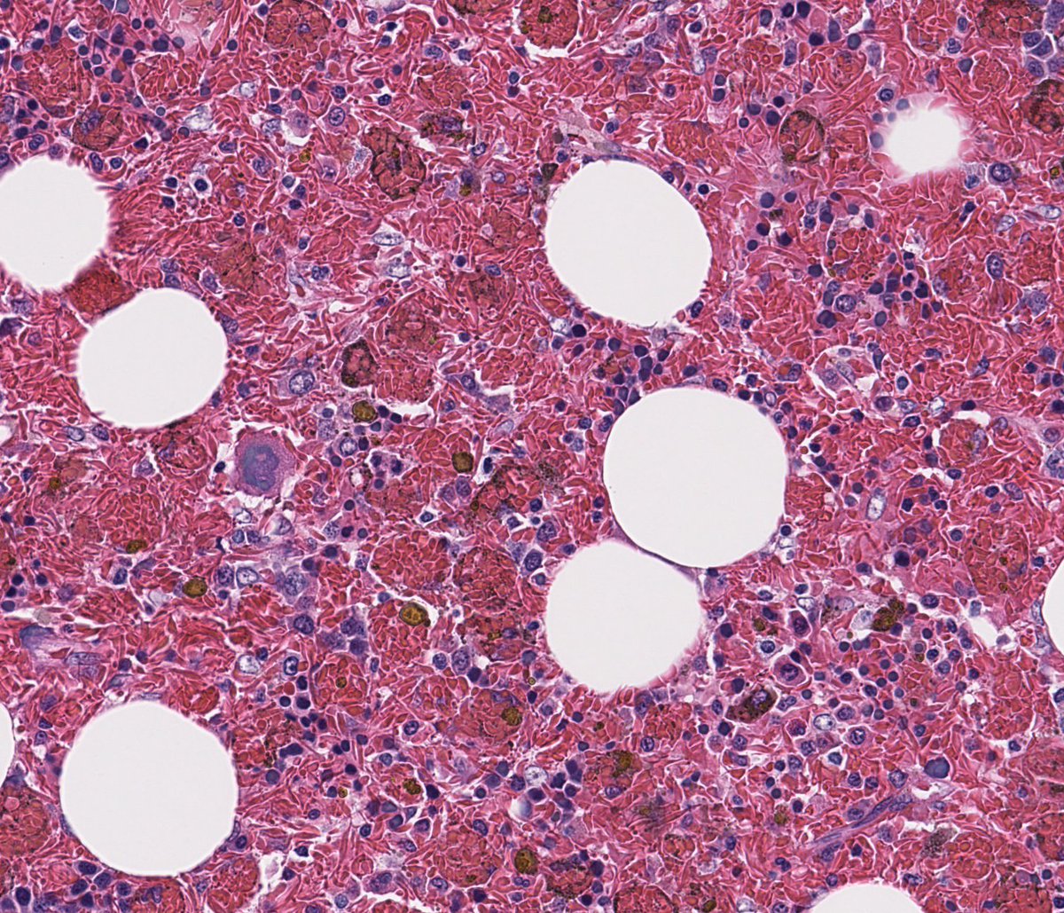 A 2 for 1!  Myelolipoma and sickle cells!