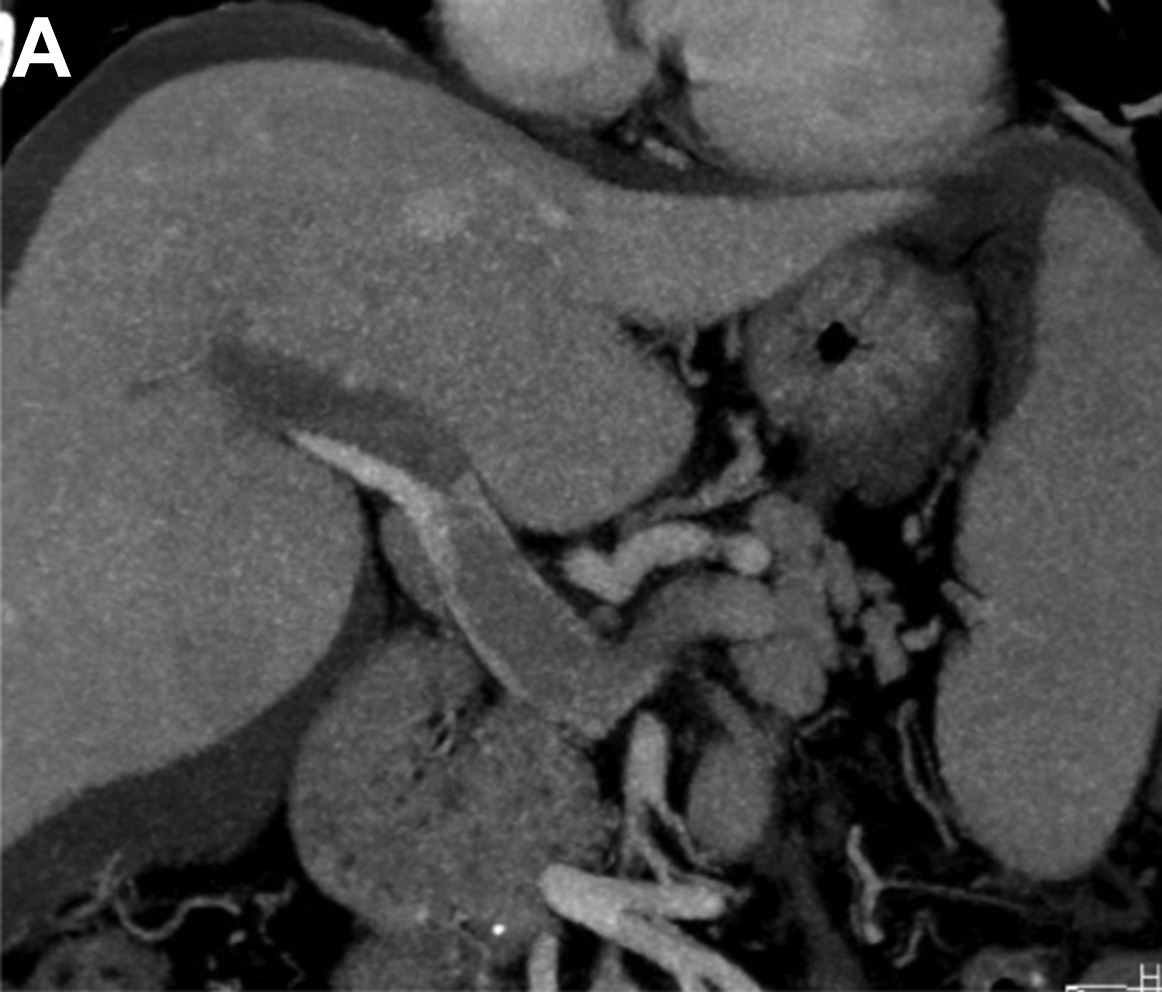 JVSVL's tweet photo. It's #VenousPhotoFriday! A 57 yo w/ severe abdominal pain was found to have acute portal vein thrombosis. When AC failed, mechanical thrombectomy was performed. A JAK2V617F mutation was identified. Check out the rest of the case details here ➡️
https://t.co/bA9hsSS7vf

#VenousEd https://t.co/sVuRWU0SoP