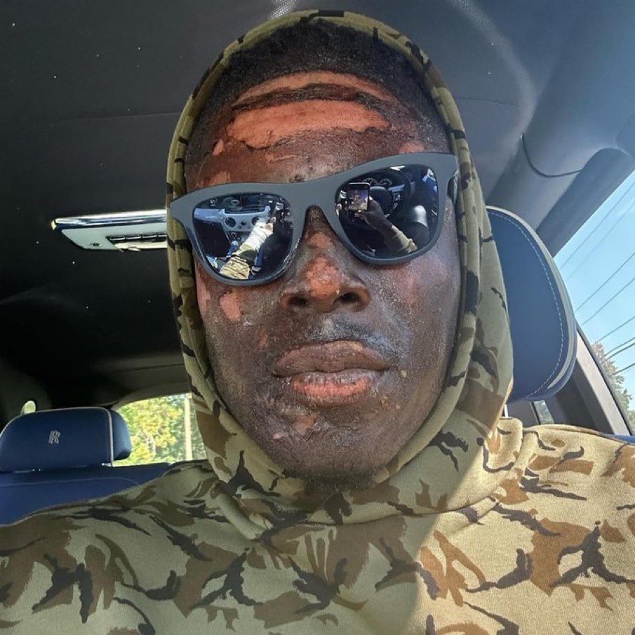 PolymarketBlitz's tweet photo. Wow. 

The #Browns David Njoku shares a photo of the burns he suffered to his face last weekend. 

He still played a few days after. 

A true warrior 😳 https://t.co/KiTzzrbhfX