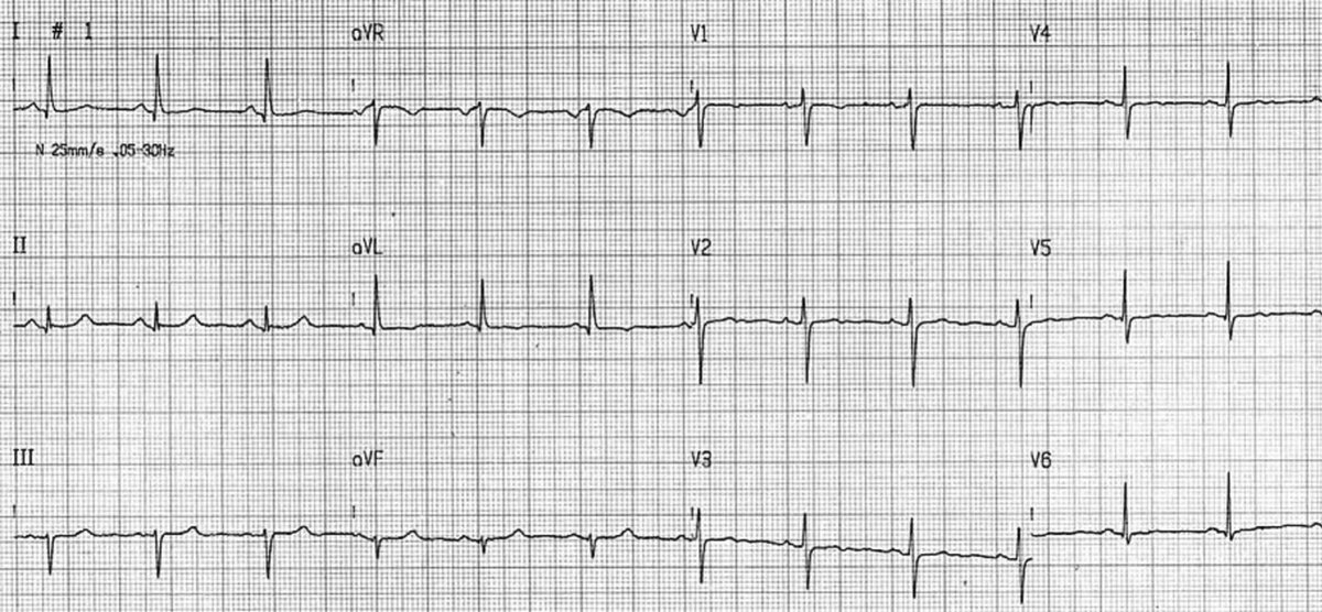 Intermittent isolated anterior displacement of QRS complex – Differential diagnosis #JECG #NewOnline #ECGoftheWeek sciencedirect.com/science/articl…