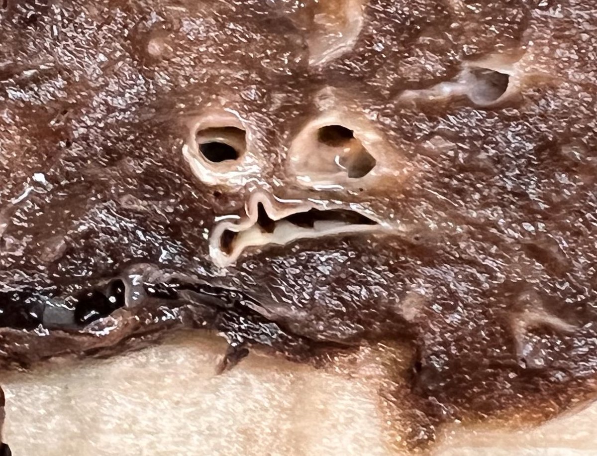 TheBatoolMD's tweet photo. When you gross a #lung in October 
🎃🎃🎃
#PathTwitter
#PathX
#Pathology https://t.co/sAkWamg34T