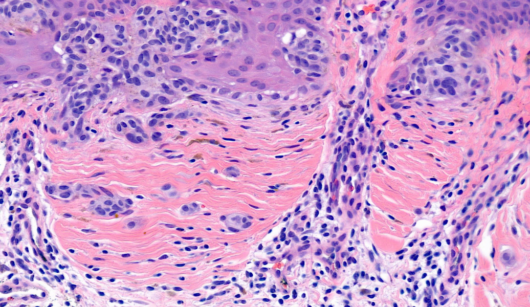 World class lamellar fibroplasia -- in a melanocytic nevus of a privileged site