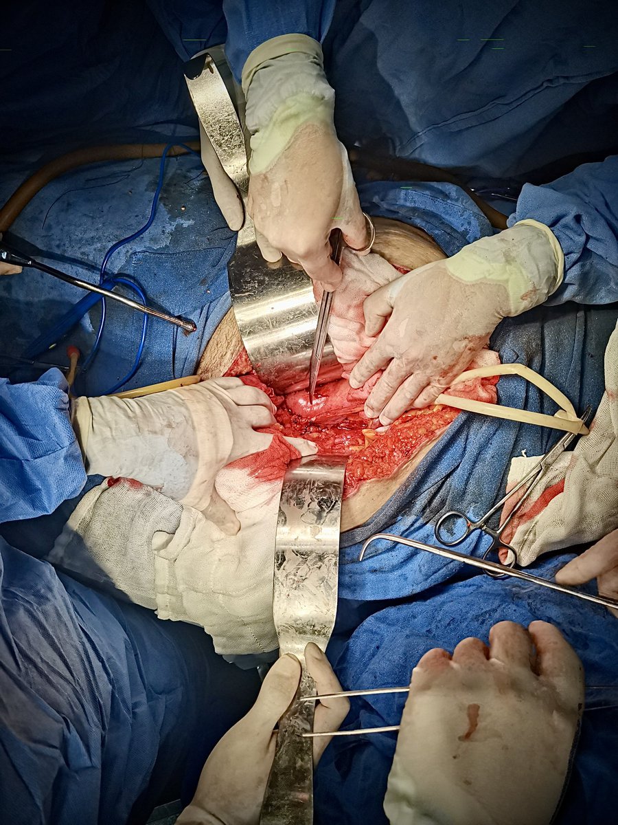 Hoy tuvimos anestesió de lujo en el reimplante ureteral. Gracias al <a href="/DrJeringas/">Dr. Jeringas</a> 🫡

#urologia #urology