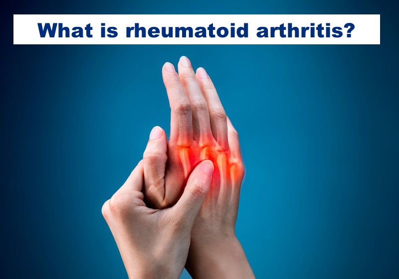 Rheumatoid arthritis is a systemic autoimmune disease where a person’s immune system attacks the lining of the joints causing inflammation & pain. It can lead to chronic damage & disability. Learn more about #RA: bit.ly/ACEaboutRAEN #WAD2023 @GlobalRANetwork @ArthritisSoc