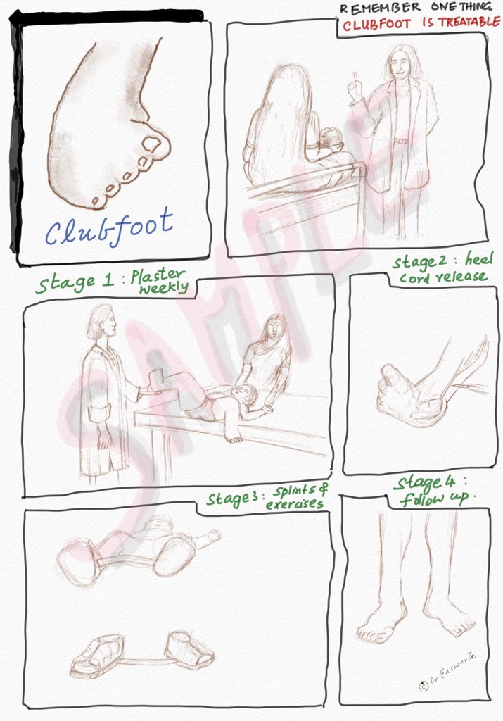 Was doodling and came up with this #awareness #handout for #clubfoot 
I’ve to finalise this and regionalise this with local languages in #india 

#medicalart 
#ArztForACause 
#medicalillustration 

@miraclefeet
@GlobalClubfoot