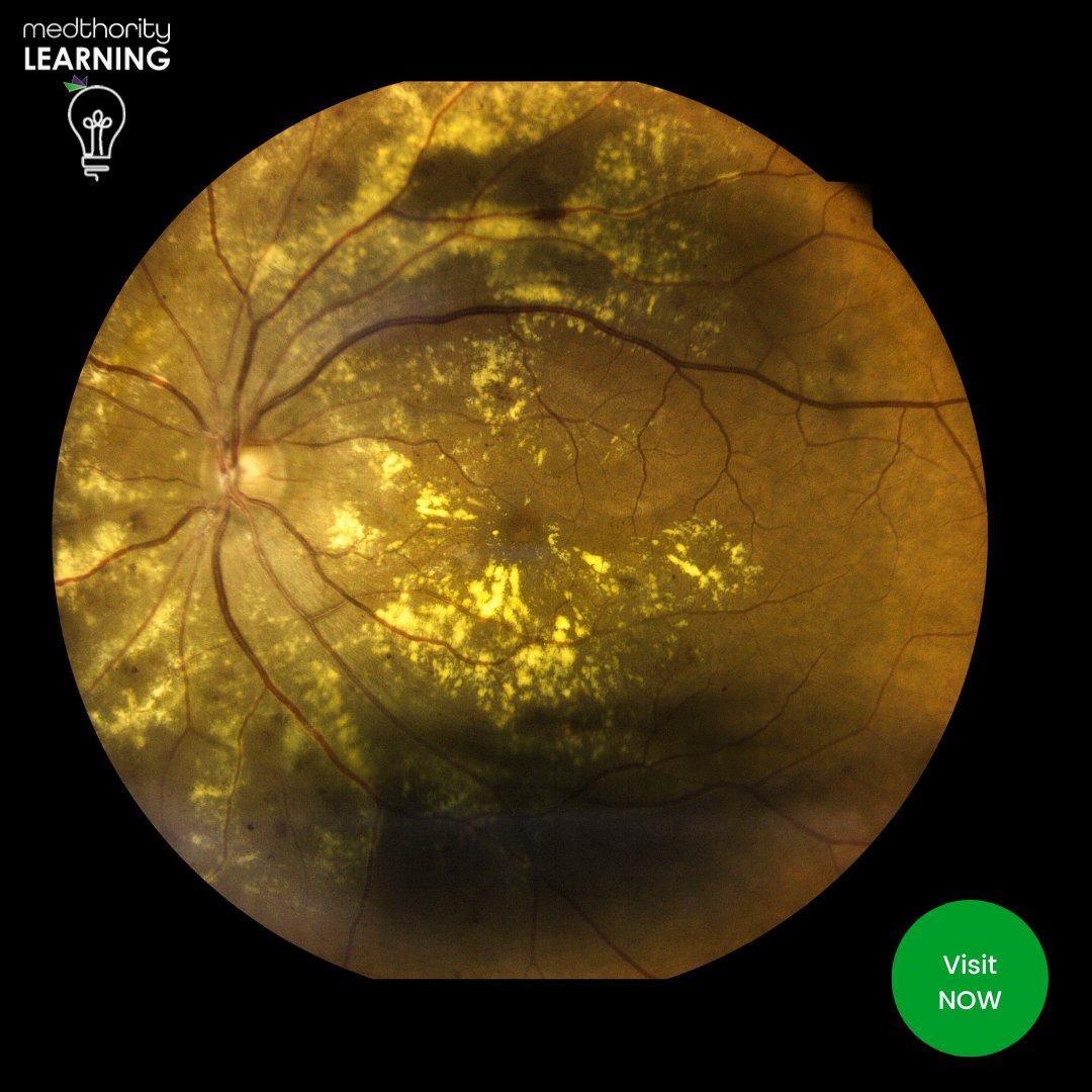 TODAY is #WorldSightDay a time to focus on #RetinalDisease education. Access FREE #Glaucoma #MacularDegeneration & #RetinalDystrophy resources on Medthority. For #HealthcareProfessionals only.

ow.ly/VN0h50POeIP

#MedEd #EyeCareEverywhere 

Content developed by #Medthority
