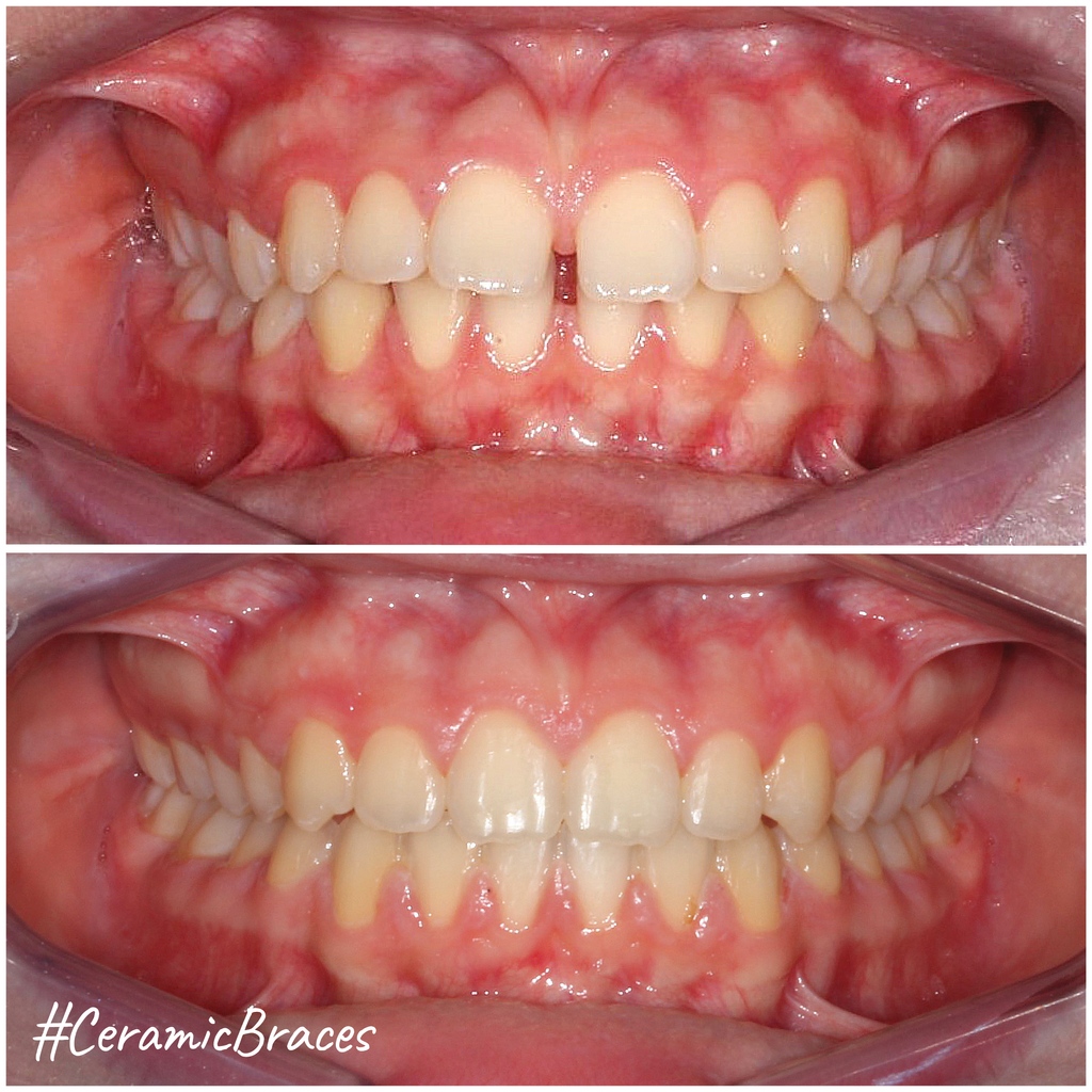 MicrisDental's tweet image. This #patient had a case of protruding #upperteeth. Adding to their trouble was a traumatic #deepbite &amp;amp; spaces between the upper &amp;amp; lower teeth.

Fortunately, our #orthodontist, Dr. Omar Said used #ceramicbraces to reduce upper teeth protrusion, giving the patient his #lostsmile.