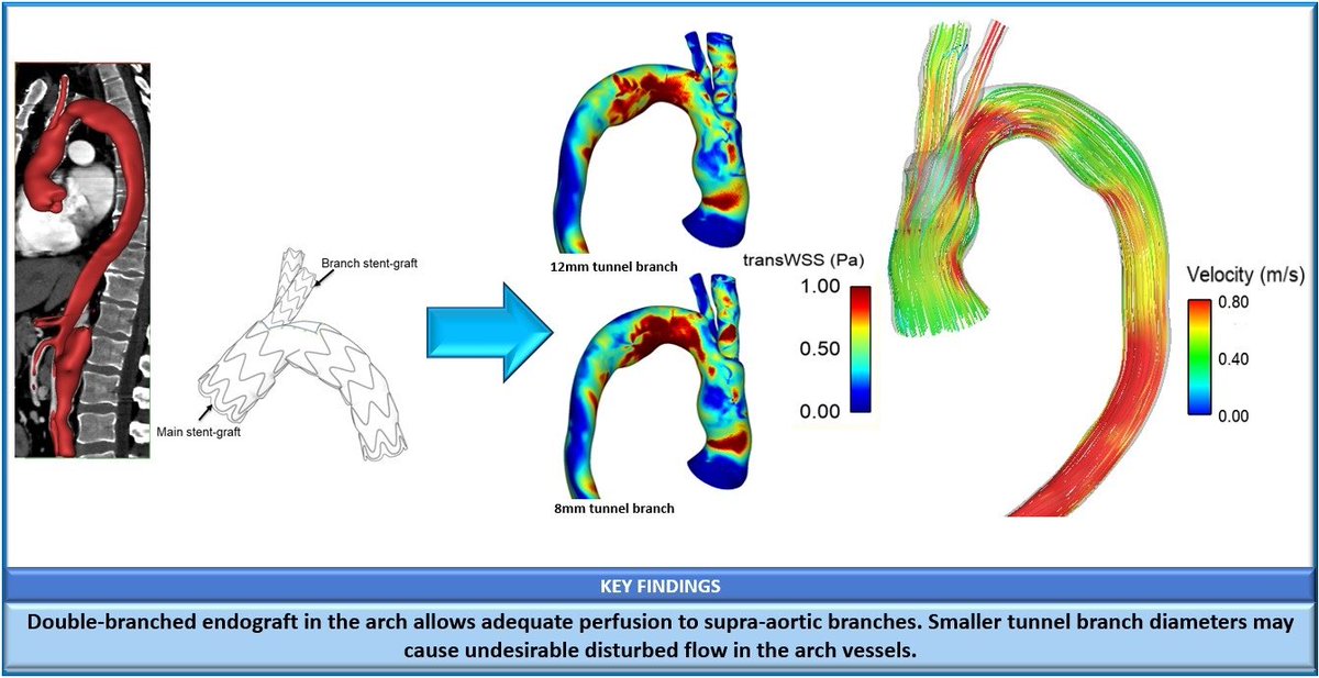 Bioeng_MDPI's tweet image. Excited to share the article: "Haemodynamic Analysis of Branched Endografts for Complex Aortic Arch Repair"✨
🥼 Authored by Sampad Sengupta, Mohamad Hamady and Xiao-Yun Xu
🔗 Welcome to read and download: mdpi.com/2306-5354/9/2/…
#aorticarch
#graft
#computationalfluiddynamics