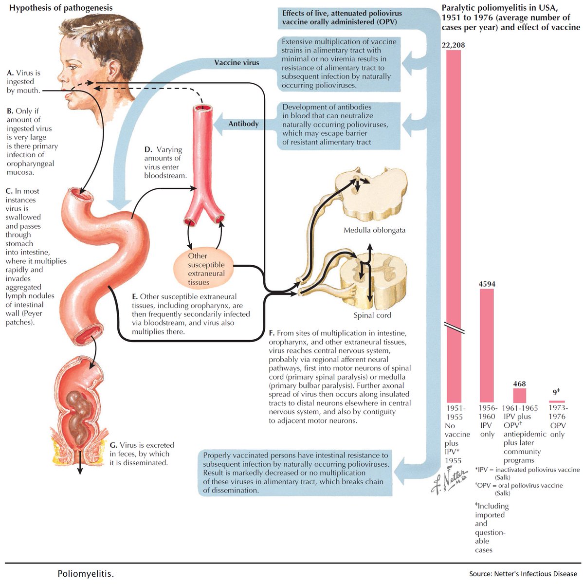 Pathogenesis of Poliomyelitis

#medtwitter #foamed #meded