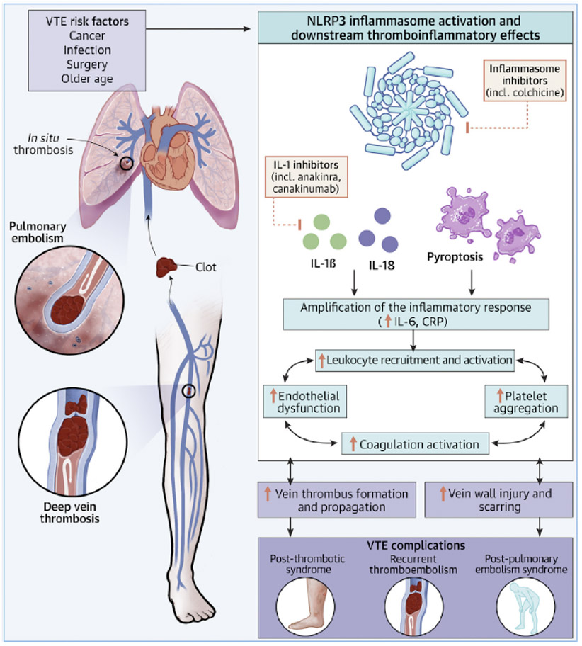 #JACCBTS state-of-the-art review provides an overview of preclinical and clinical evidence supporting IL-1 and the NLRP3 inflammasome as potential therapeutic targets in #VTE: bit.ly/45qTx5Z #CardioTwitter @NicolaPotereMD @YogenKanthi @MarcCarrier1 @MarcelloDiNisio