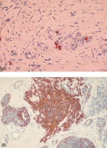 EUplatinum's tweet photo. Throwback Thursday: Neuroendocrine Differentiation in Prostate Cancer: Implications for New Treatment Modalities 

https://t.co/4dKxHxKZ4D 

#throwbackthursday #medtwitter #UroSoMe https://t.co/R0nOHDUUwR