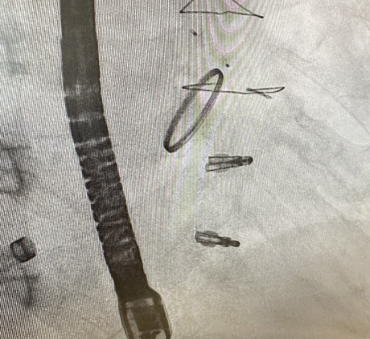 Concurrent MV paravalvular leak closure and TriClip x 2. Great team collaboration! @khungkeong @jacktanwc @ningyan_wong #nhcs #structuralintervention #CardioTwitter